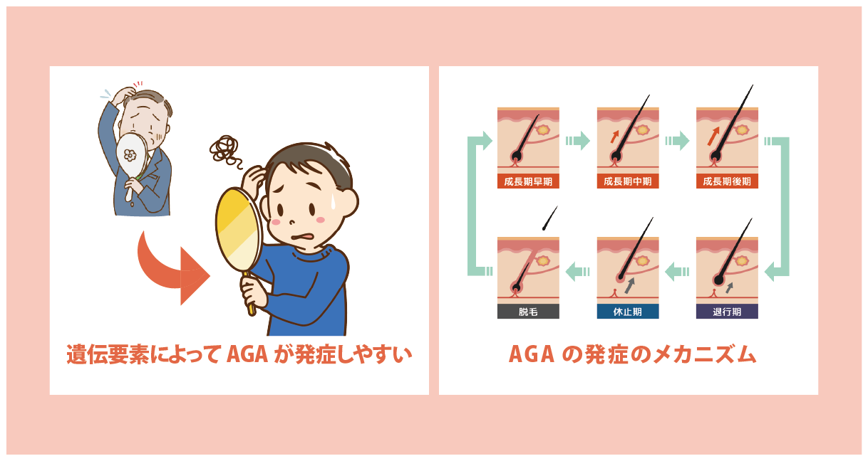 AGAが発症しやすい人の特徴や抜け毛の原因