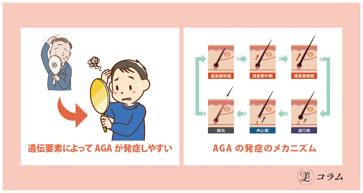 AGAが発症しやすい人の特徴や抜け毛の原因