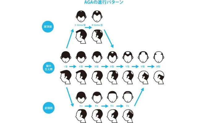 AGAによる薄毛の進行度は3パターンある