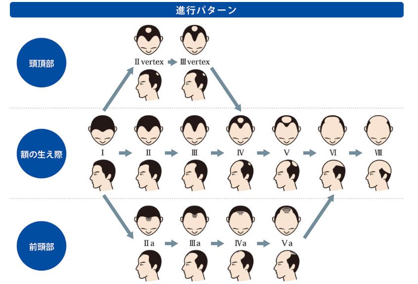 AGA(男性型脱毛症)