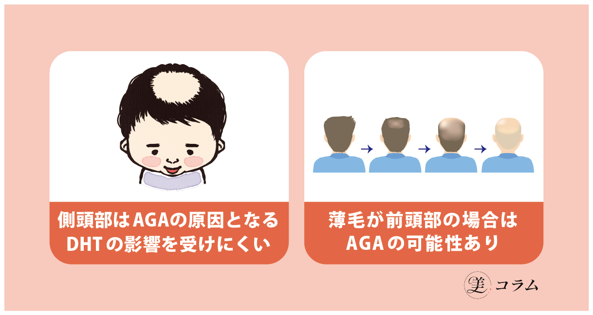 側頭部の薄毛とAGAの関係性