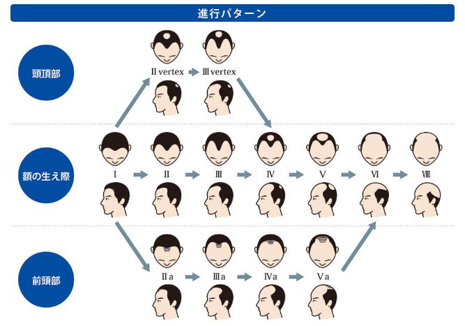 AGAの進行パターン